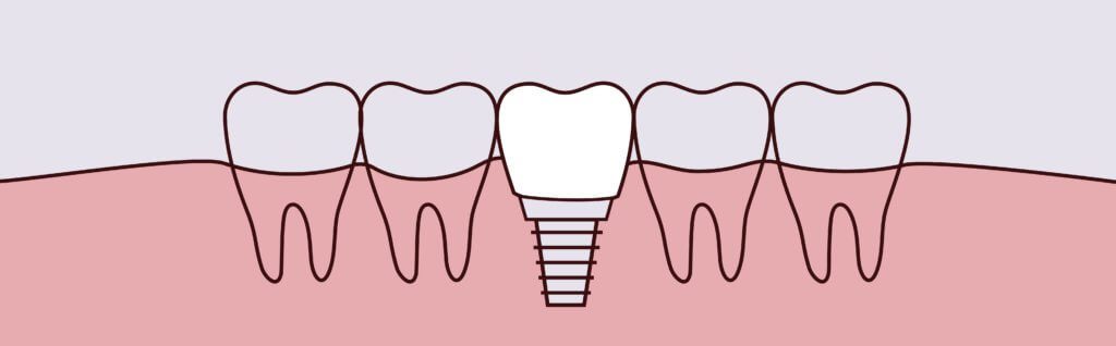Dental Implants Image - Midtown General and Cosmetic Dentistry in Charlotte NC