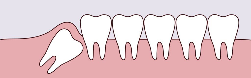 Midtown General & Cosmetic Dentistry Wisdom teeth removal Dreamscape Imagery 08 1024x318 1